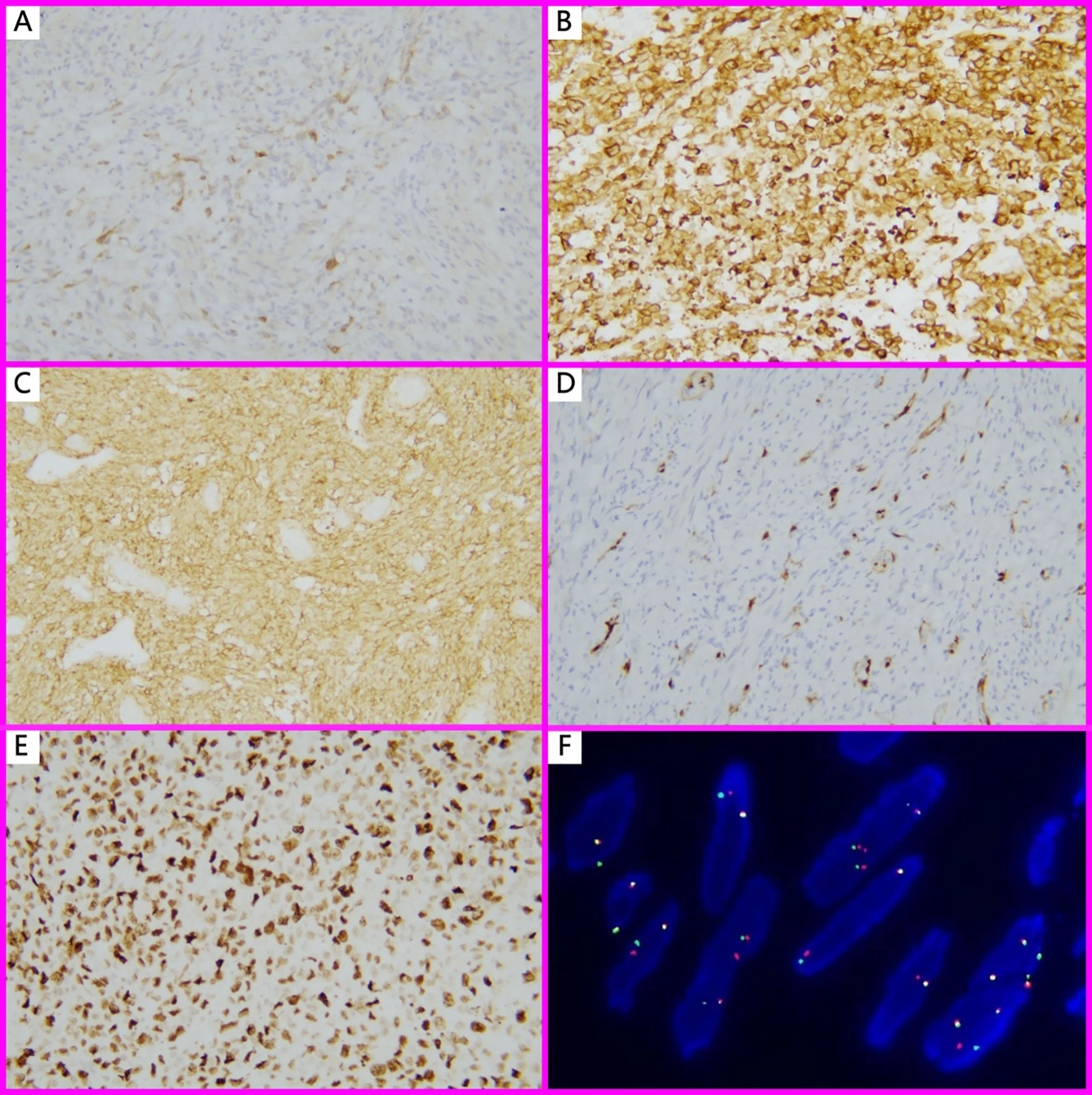 Panel of six microscopic images labeled A to F, showing tissue samples with varying staining patterns. A and D display light staining, B and E show dense brown staining, C has a uniform light stain, and F features fluorescent signals on blue-stained structures.