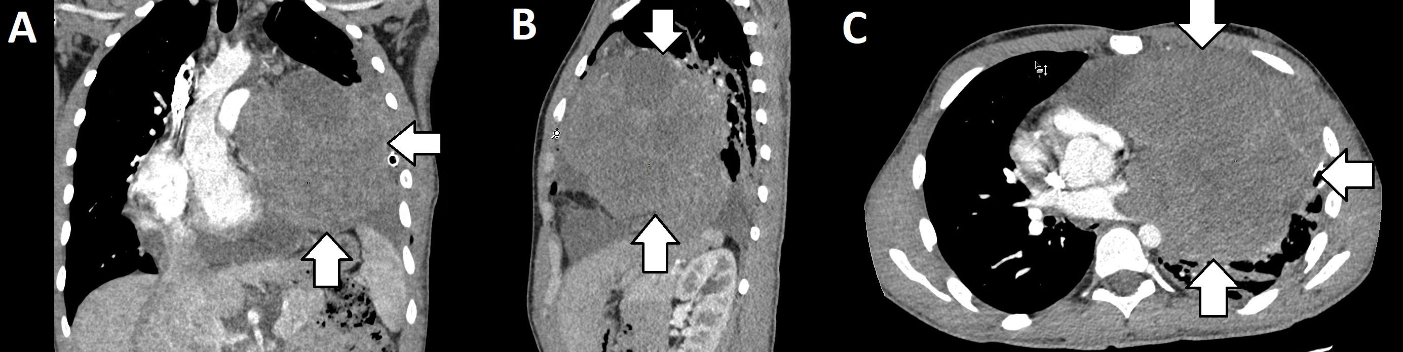 CT scan images labeled A, B, and C. Image A shows a coronal view of the chest with arrows indicating a mass. Image B presents a sagittal view, highlighting the same mass. Image C provides an axial view, displaying the mass prominently.