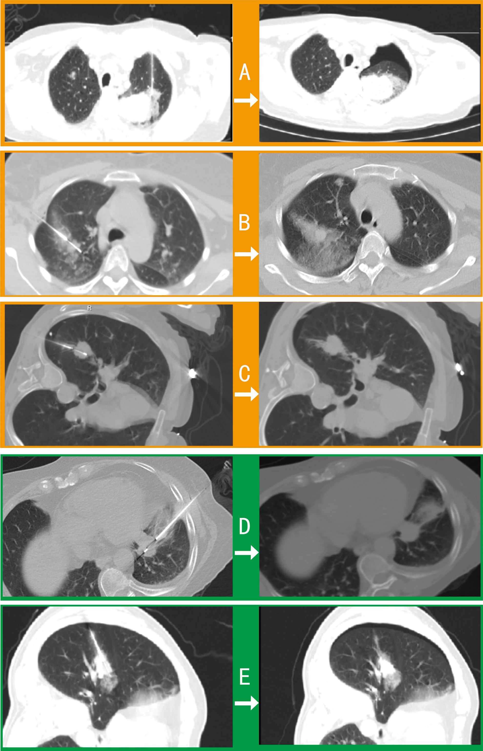 Axial CT scans (A-E) comparing intraprocedural (left) and postprocedural (right) lung images. Cases show complications including pneumothorax and hemorrhage, with varying clinical outcomes from drainage to no intervention.