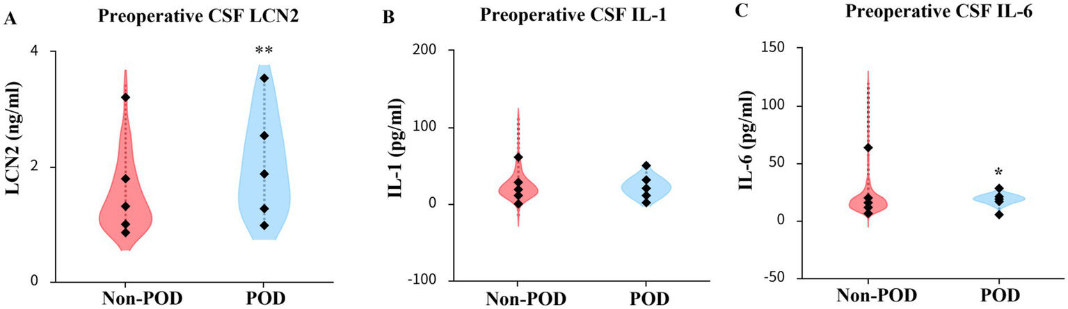 Violin plots displaying preoperative cerebrospinal fluid levels of LCN2, IL-1, and IL-6. Panel A shows higher LCN2 levels in POD than Non-POD. Panel B shows similar IL-1 levels across groups. Panel C shows lower IL-6 levels in POD than Non-POD. Statistical significance is noted in panels A and C with asterisks.