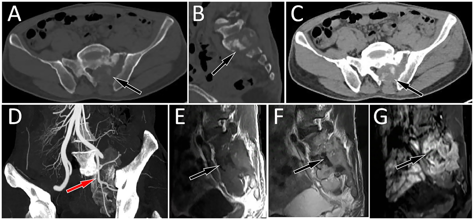 CT and MRI images showcasing a pelvic bone infection. Panels A, B, and C display CT scans, each marked by arrows indicating areas of concern. Panel D shows a CT angiogram with an arrow highlighting a significant vascular issue. Panels E, F, and G present MRI scans, with arrows pointing to inflammation or abscesses in the pelvis.
