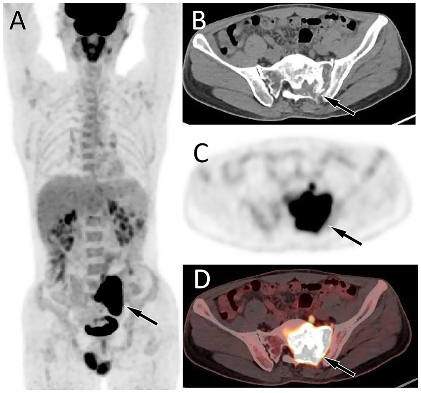 Four medical scan images labeled A to D. A: Full-body PET scan indicating dark areas in the lower abdomen. B: CT scan of the pelvis showing highlighted regions around the sacrum indicated by an arrow. C: PET scan of the pelvic region focusing on a dark spot. D: Combined PET/CT scan of the pelvis, where a bright region in the sacrum is marked by an arrow.