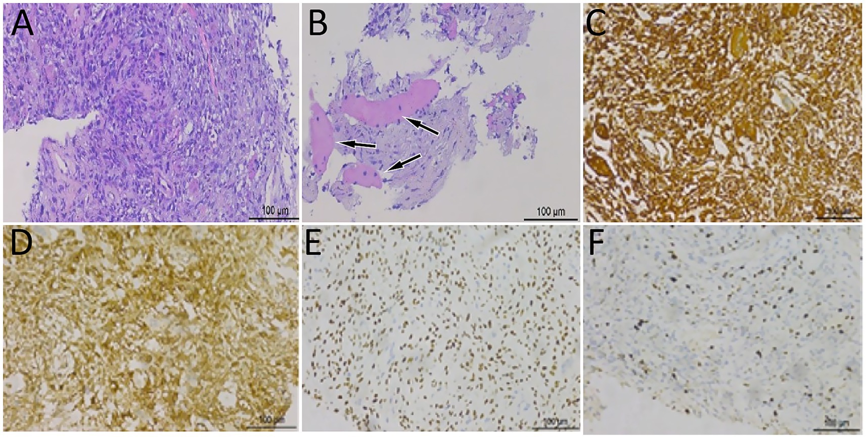 Histological image showing six panels labeled A to F, displaying different tissue staining results. Panel A and B feature tissue samples with purple and pink staining. Panel C and D show areas with brown coloration, indicating positive staining. Panel E and F display lighter staining with numerous dark spots across the tissue. Each panel includes a scale bar for reference.