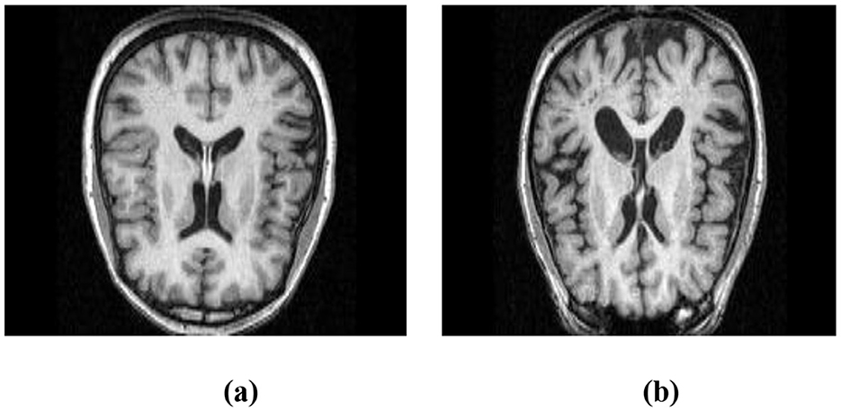 Two MRI brain scans are shown side by side. Image (a) shows a coronal view with clear delineation of the ventricles and cerebral structures. Image (b) presents a different coronal view with similar features but slightly altered ventricle positioning. Both images highlight the brain's internal anatomy.