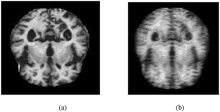 MRI scans showing coronal sections of a human brain. Image (a) appears clear with distinct brain structures, while image (b) is more blurred, with less visible detail.
