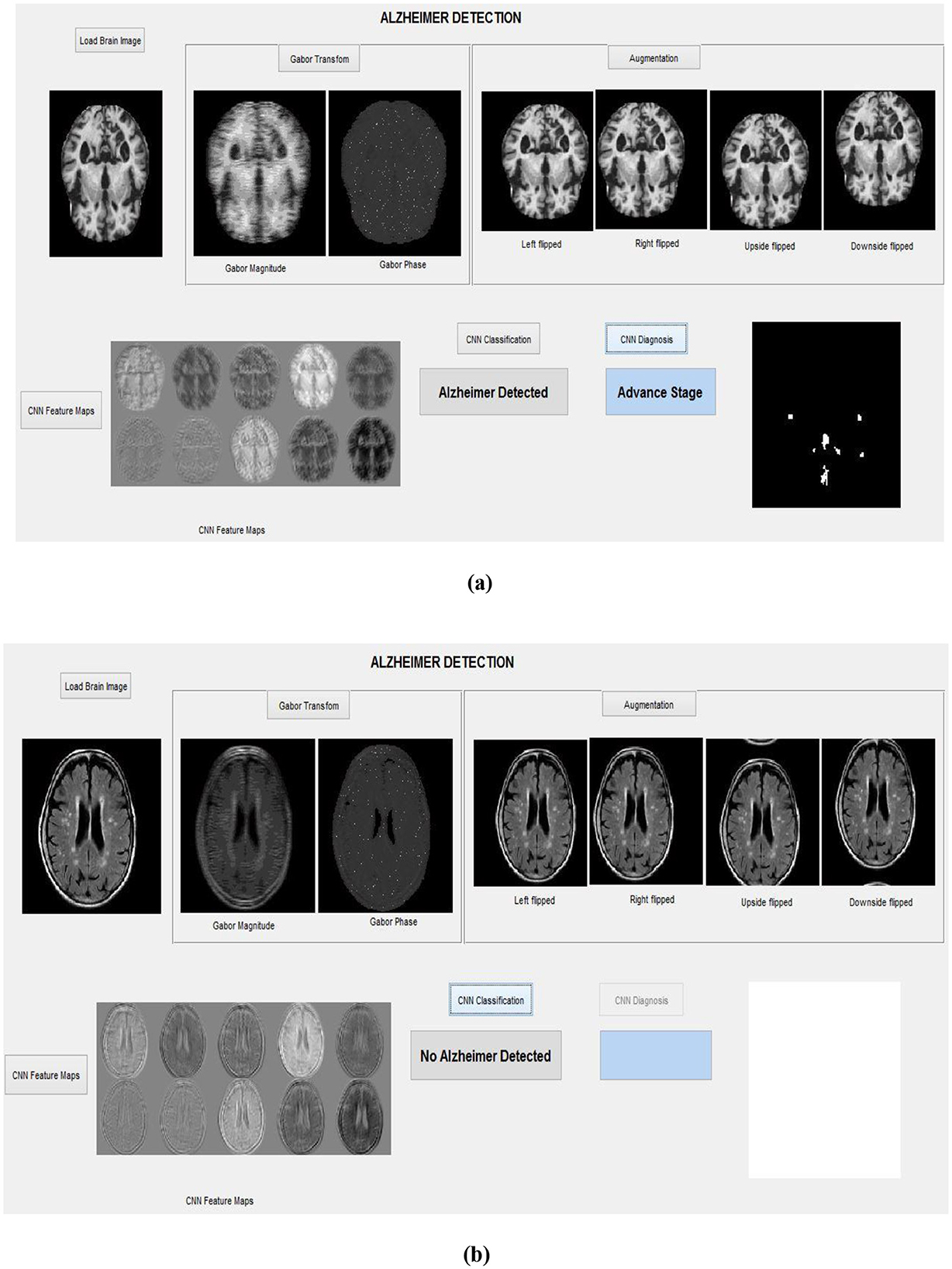 (a) A graphical user interface for Alzheimer detection showing brain images processed through Gabor transformation and augmentation techniques, with CNN feature maps. The classification indicates Alzheimer Detected, and the diagnosis shows Advance Stage. (b) Similar interface with different brain images showing a No Alzheimer Detected classification, with the diagnosis area blank.