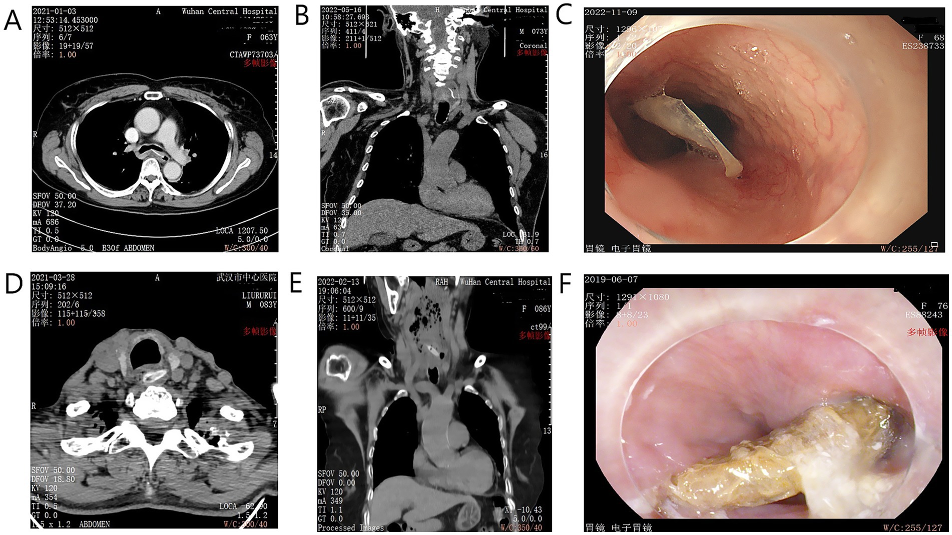 Image panel A shows a CT scan of the chest with axial view highlighting cardiovascular structures. Panel B is a coronal CT scan displaying the thoracic anatomy. Panel C depicts an endoscopic view of the esophagus, showing an obstruction. Panel D provides an axial CT scan of the neck area. Panel E presents a coronal CT scan focusing on the upper thorax. Panel F shows an endoscopic view of the stomach with visible foreign material.
