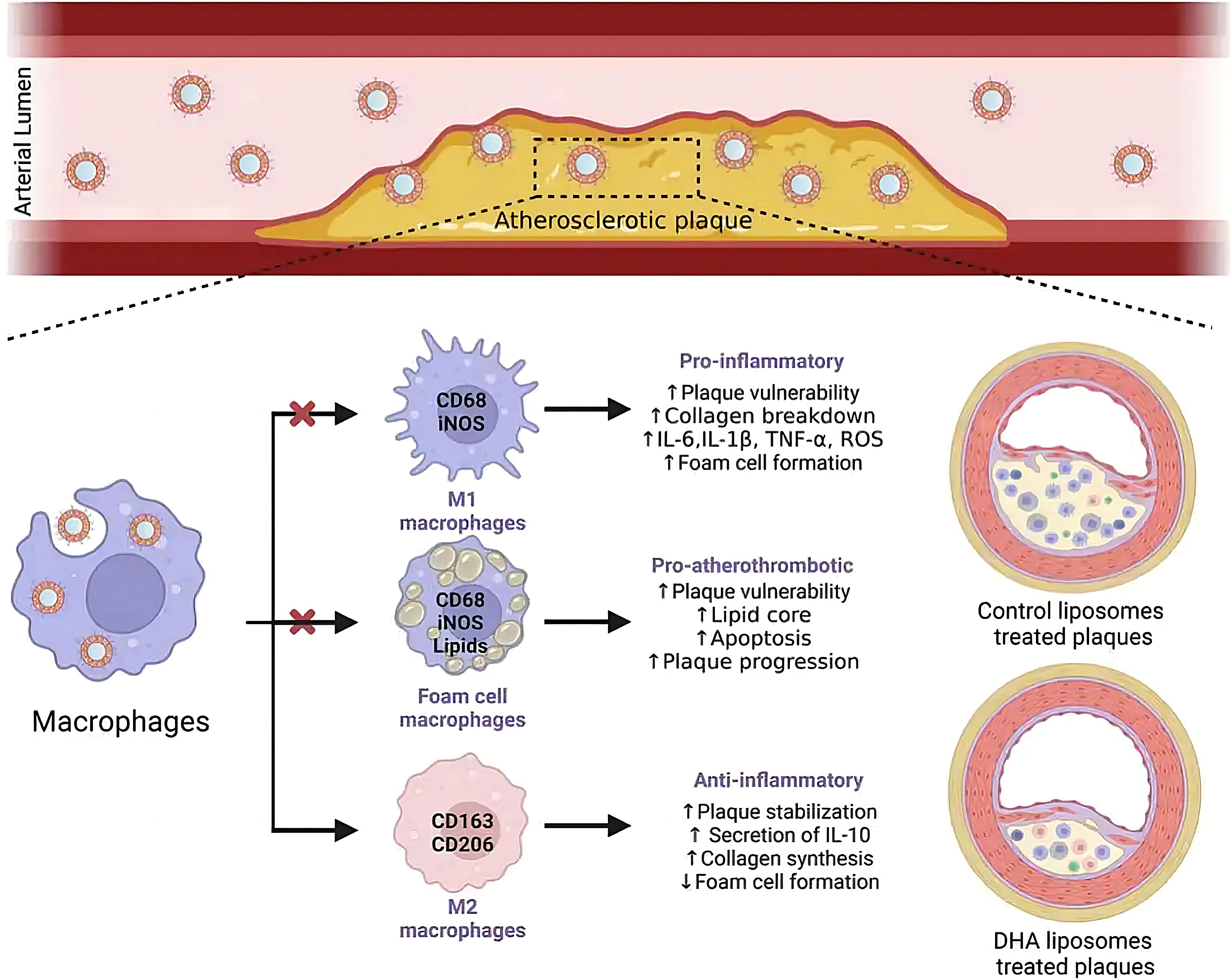 Cross-section diagram illustrating atherosclerotic plaque in an arterial lumen. The image highlights macrophage differentiation into M1 (pro-inflammatory), foam cell (pro-atherothrombotic), and M2 (anti-inflammatory) types. Effects include plaque vulnerability, collagen breakdown, and stabilization. On the right, comparison between control and DHA liposome-treated plaques shows differences in plaque composition and inflammation response.
