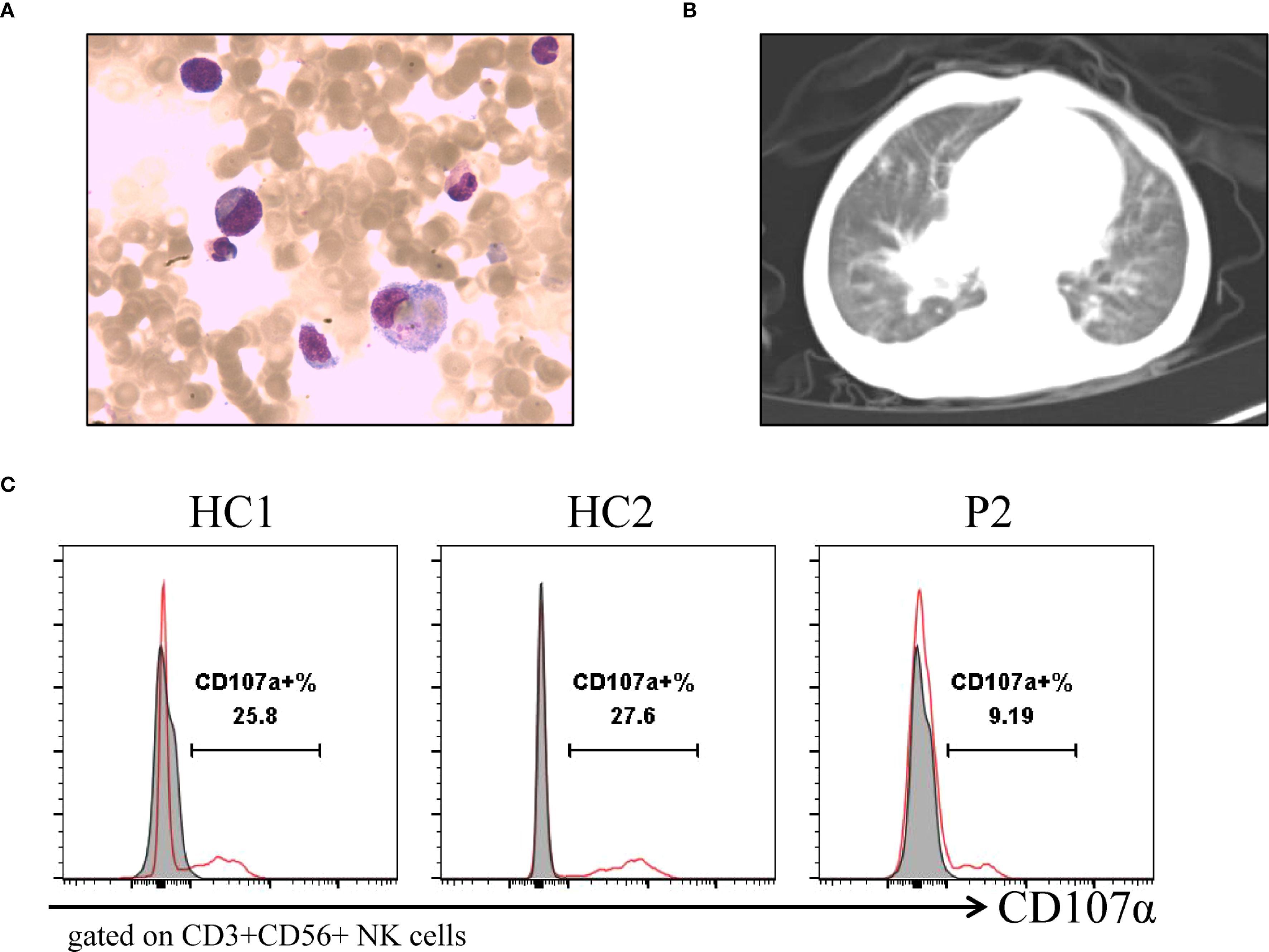 Panel A shows a micrograph of blood cells with visible blue-stained leukocytes. Panel B displays a chest CT scan with lung structures visible. Panel C consists of three flow cytometry histograms labeled HC1, HC2, and P2. They show CD107a expression levels on gated CD3+CD56+ NK cells, with percentages of 25.8 in HC1, 27.6 in HC2, and 9.19 in P2.