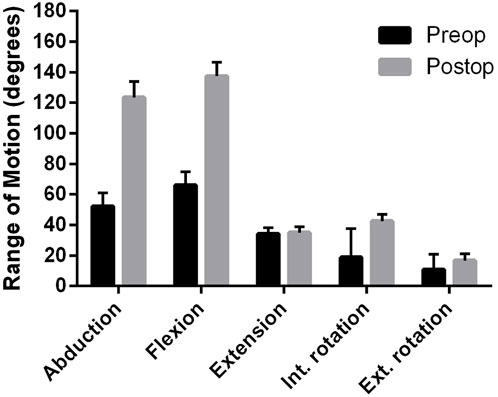 Bar chart showing range of motion in degrees for different movements: abduction, flexion, extension, internal rotation, and external rotation. Preoperative (black) and postoperative (gray) measurements indicate an increase in motion postoperatively, especially in flexion.