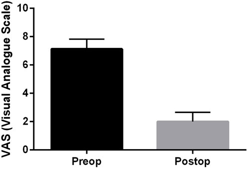Bar graph illustrating Visual Analogue Scale (VAS) scores. The preoperative (Preop) score is around 8, depicted by a tall black bar. The postoperative (Postop) score is about 2, shown by a shorter gray bar. Error bars indicate variability.