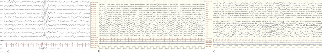 Three sections of EEG waveforms labeled a, b, and c, each displaying brain activity readings with different electrode channels including Fp1, Fp2, and O1. The waveforms show various patterns, indicating changes in brain signals over time, with a red line indicating the heartbeat and two blue lines representing muscle tension.