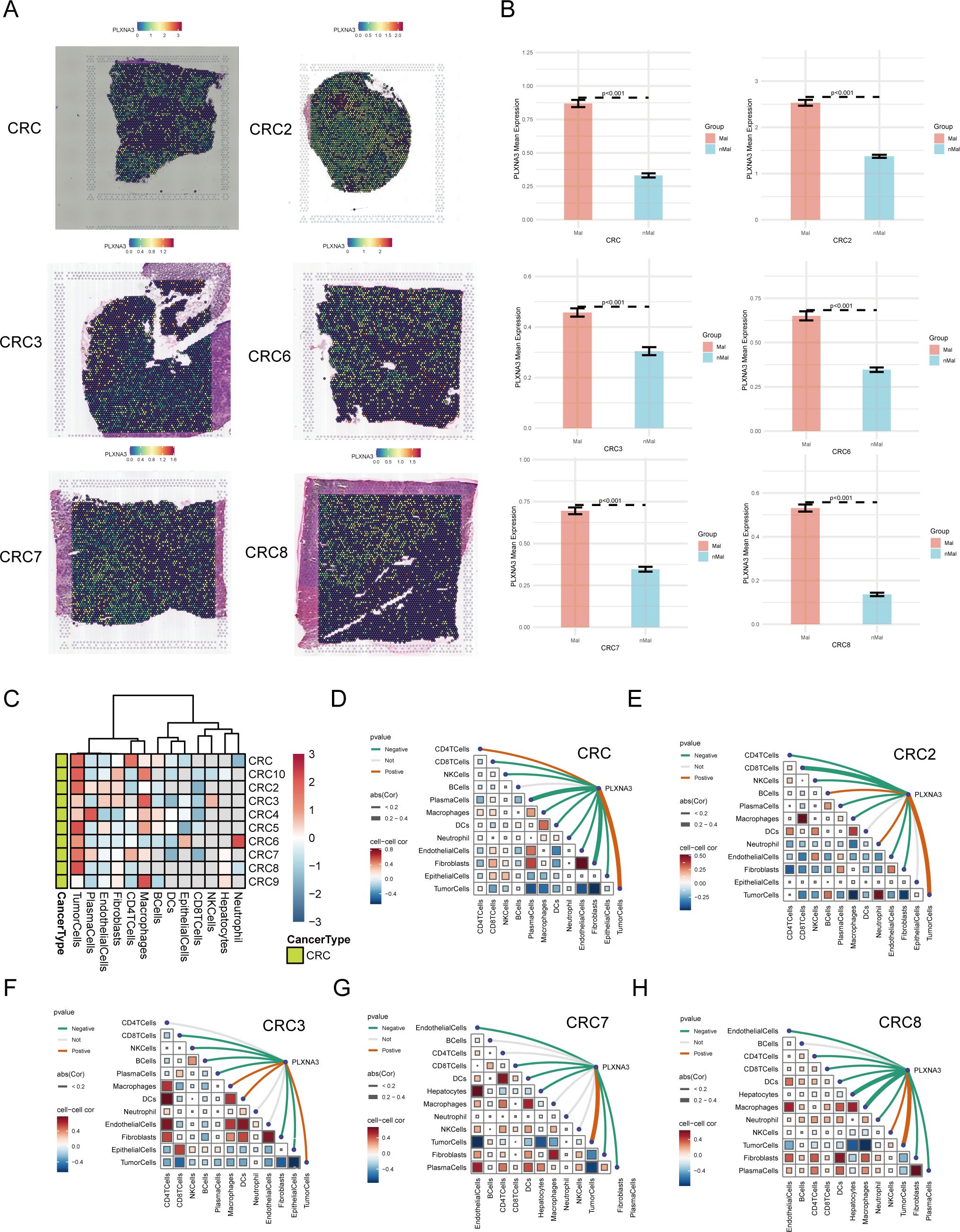 Panel A shows six CRC samples with heat maps, indicating distinct patterns. Panel B presents bar graphs comparing PLXN3A expression in different groups, with statistical significance marked. Panel C displays a clustered heat map analyzing cancer cell types across samples. Panels D, F, G, H, and I contain circular correlation diagrams illustrating relationships between PLXN3A and various cell types in specific samples, with p-values noted. Each visualization helps examine cellular and molecular characteristics in CRC.