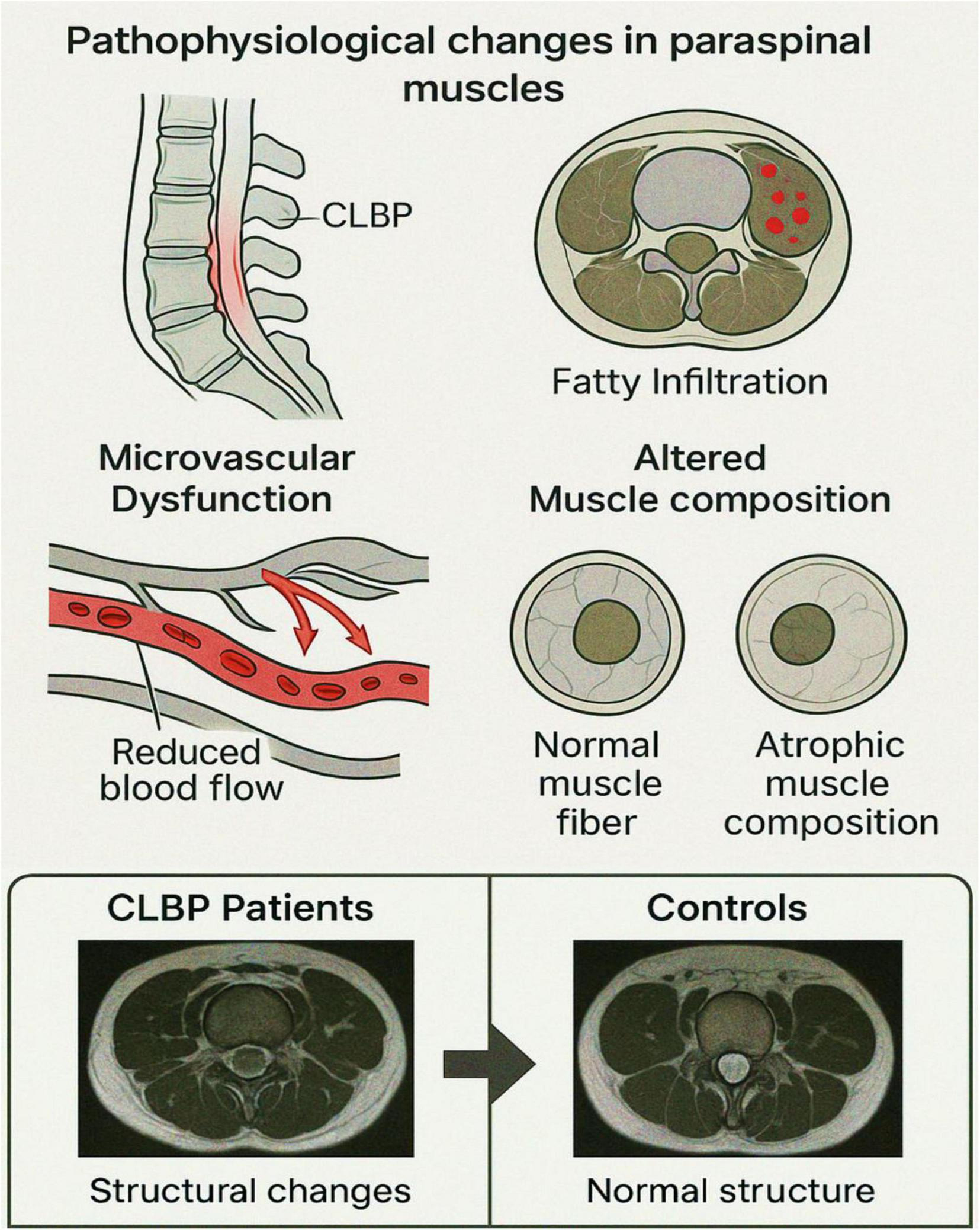 Illustration titled “Pathophysiological changes in paraspinal muscles” showing effects in Chronic Low Back Pain (CLBP). It includes diagrams of microvascular dysfunction indicating reduced blood flow, fatty infiltration, and altered muscle composition, contrasting normal and atrophic muscle fibers. Below, MRI images compare structural changes in CLBP patients to normal structures in controls.