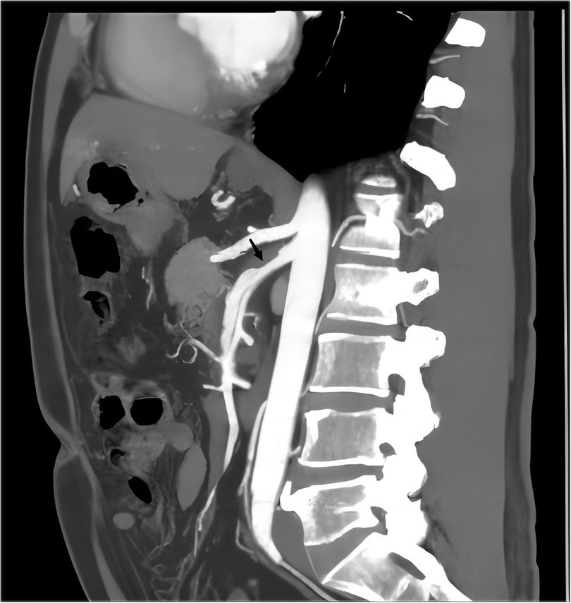 CT scan showing a sagittal view of the human abdomen and spine. The spinal column is clearly visible on the right, with vertebrae highlighted. An arrow points to a specific area near the abdominal aorta.