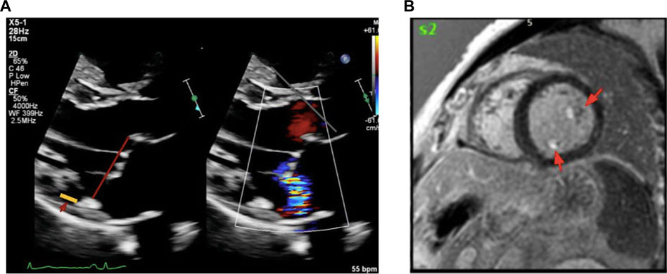Panel A shows an ultrasound with Doppler imaging, highlighting blood flow with red and blue colors, and marked with a red arrow and a yellow bar. Panel B is a MRI scan displaying a cross-section with two red arrows indicating specific areas.