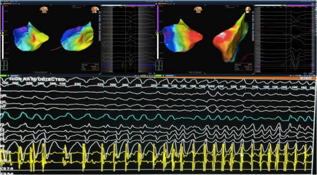 Medical imaging showing a electrophysiology 3D mapping system with heart models with color-coded regions, indicating different areas of activity. Below are various waveform tracings, labeled with numbers, displaying electrical heart activity over time. The text “High Rate Detected” is visible above the waveforms.