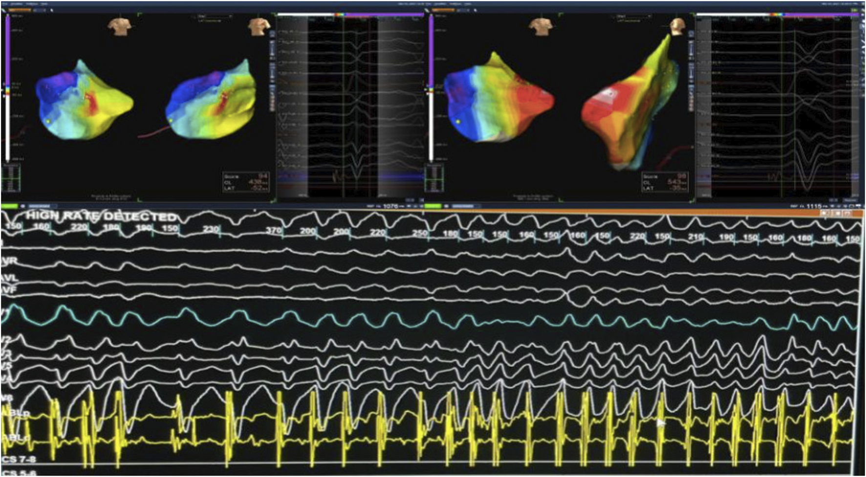 Medical imaging showing a electrophysiology 3D mapping system with heart models with color-coded regions, indicating different areas of activity. Below are various waveform tracings, labeled with numbers, displaying electrical heart activity over time. The text “High Rate Detected” is visible above the waveforms.
