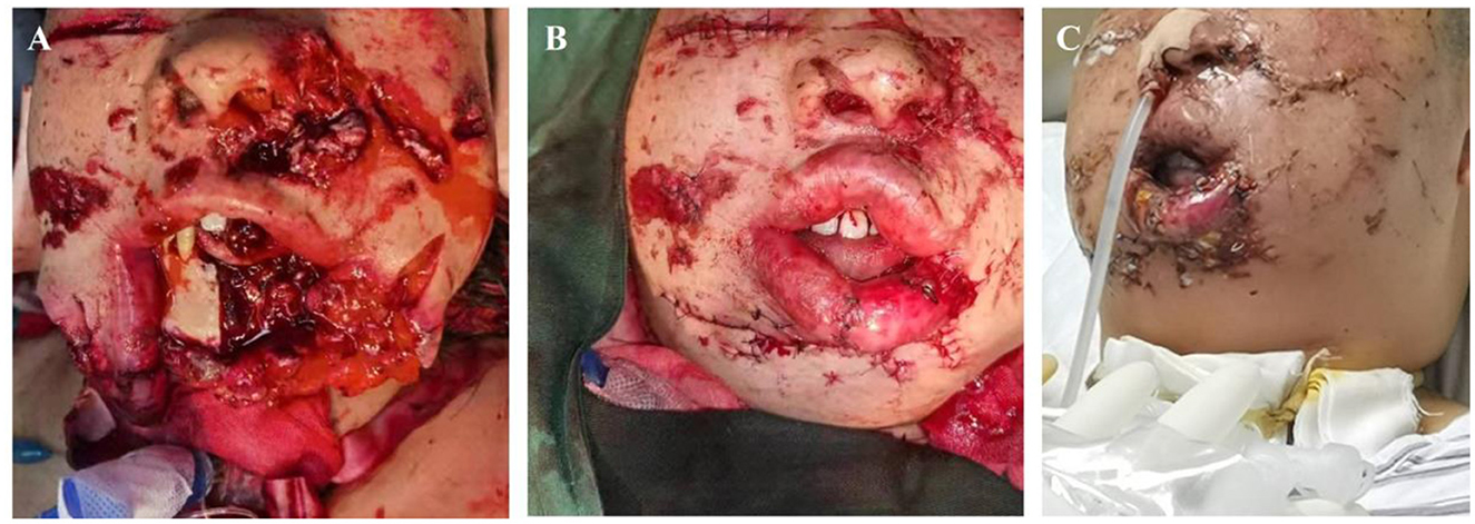 Three-panel image showing a patient's facial injuries and reconstruction. Panel A shows severe facial trauma with exposed tissue and bone. Panel B displays partial suturing and swelling. Panel C shows further healing with sutures and significant swelling, along with a tube inserted for drainage.