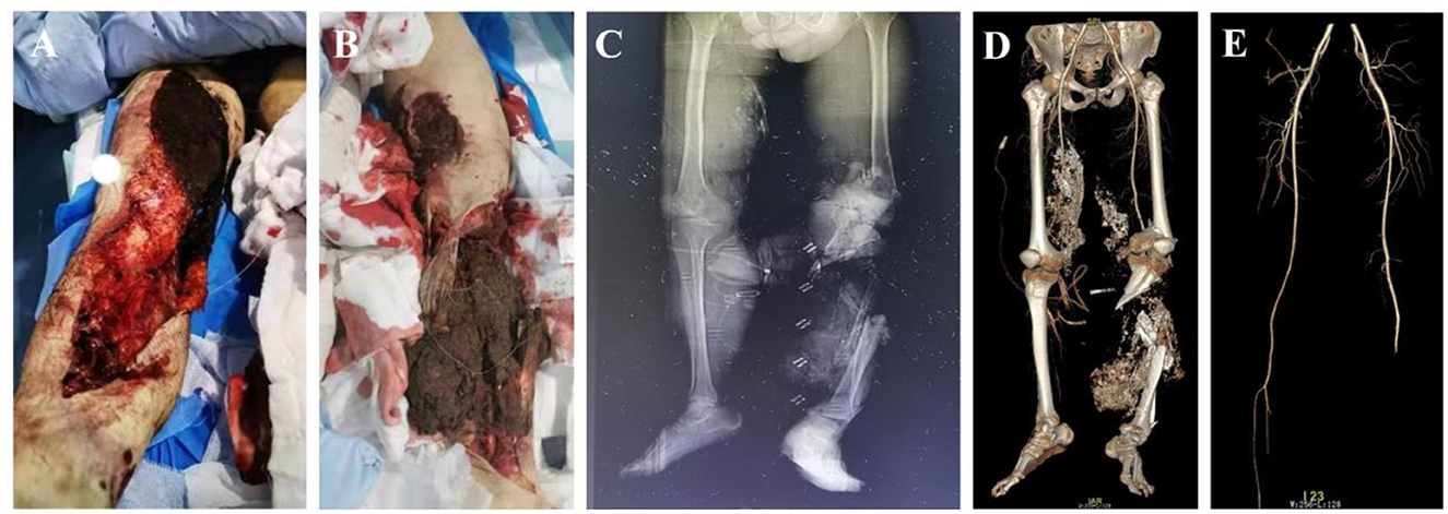 Images labeled A and B show severe soft tissue injuries on a leg, with exposed muscle and tissue damage. Image C is an X-ray revealing skeletal structure and potential foreign objects in the leg. Image D is a 3D skeletal scan highlighting fractures and bone alignment. Image E displays a detailed angiography of the leg arteries, showing vascular pathways.