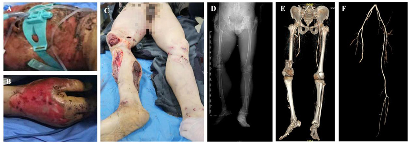 Panels A to F show medical images of a patient with severe burns and injuries. Panel A depicts the patient's back with extensive burns, secured with medical equipment. Panel B shows a close-up of a burned hand. Panel C illustrates severe leg injuries and open wounds. Panel D presents an X-ray of the lower body indicating skeletal alignment. Panel E reveals a detailed skeletal scan. Panel F features a comparative image resembling a tree branch, emphasizing structural damage.