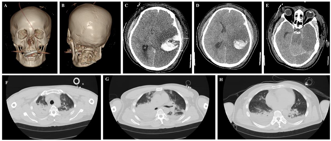 Panels A and B feature 3D reconstructions of a skull with visible fractures. Panels C, D, and E show axial CT scans of the brain, highlighting intracranial hemorrhages. Panels F, G, and H display axial CT scans of the thorax, indicating significant lung abnormalities and fluid accumulation.