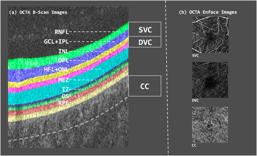 OCT angiography images showing two parts: (a) B-scan with labeled retinal layers including RNFL, GCL+IPL, INL, OPL, HFL+ONL, MEZ, IZ, OS, and RPE with areas SVC, DVC, and CC marked; (b) Enface images displaying vascular patterns for SVC, DVC, and CC.