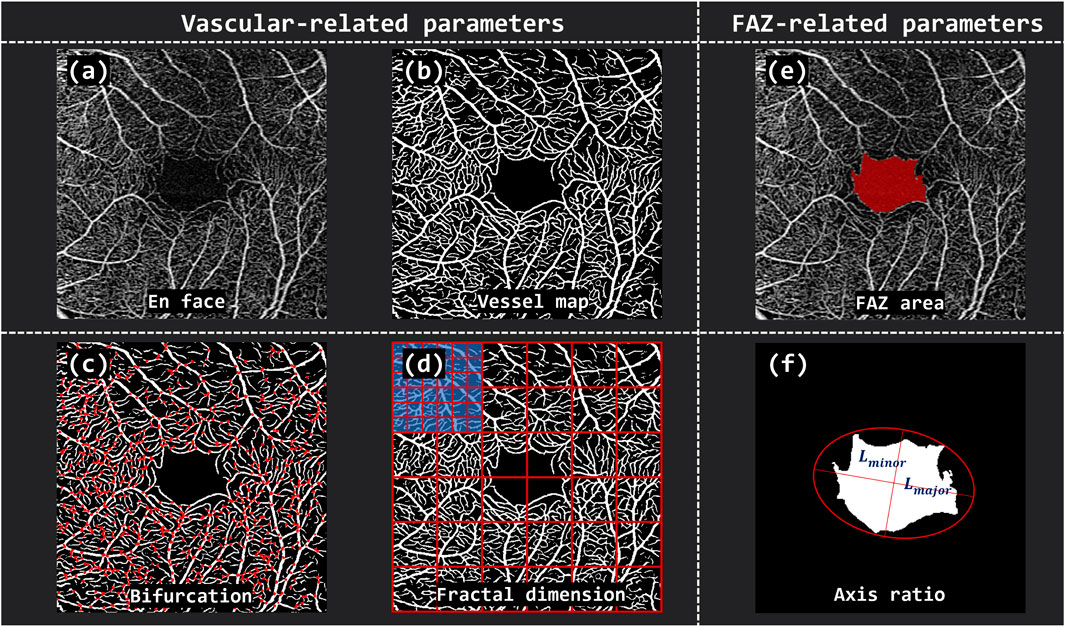 Composite image showing vascular-related and FAZ-related eye parameters. (a) En face, depicting initial vascular structure. (b) Vessel map, displaying highlighted white vessels. (c) Bifurcation, showing red points where vessels split. (d) Fractal dimension, with a grid overlay analyzing complexity. (e) FAZ area, the central red-highlighted zone. (f) Axis ratio, illustrating a shape with major and minor axes labeled.