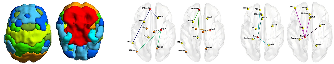 Diagram illustrating a dual-driven hypergraph learning system for functional MRI data processing. It includes three sections: data preprocessing, knowledge-driven hypergraph, and dual-driven hypergraph learning. The preprocessing uses rest-state fMRI to derive a functional matrix. The knowledge-driven hypergraph categorizes brain regions into networks like DMN, DAN, and others. The data-driven hypergraph constructs global and local networks using k-nearest neighbors and breadth-first search. The dual-driven hypergraph learning involves prior, global, and local hypergraph convolution, followed by local pooling and a multi-layer perceptron for soft voting classification.