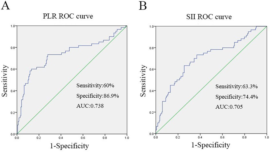 Two ROC curve graphs labeled A and B. Graph A shows the PLR ROC curve with a sensitivity of sixty percent, specificity of eighty-six point nine percent, and an AUC of zero point seven three eight. Graph B displays the SII ROC curve with a sensitivity of sixty-three point three percent, specificity of seventy-four point four percent, and an AUC of zero point seven zero five. Both graphs plot sensitivity against one minus specificity, with a diagonal reference line.