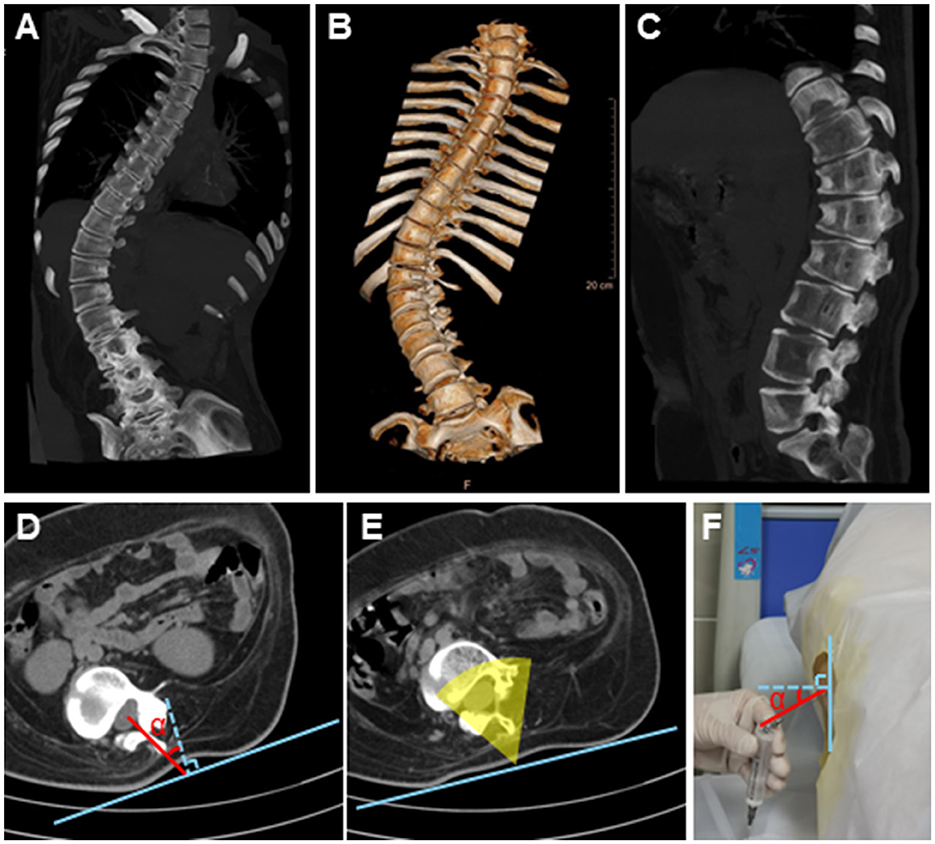 Composite of six images showing spinal scans and a medical procedure. A–C: Three-dimensional and cross-sectional spinal views, highlighting alignment. D–E: Cross-sectional scans with angle indicators, showing a needle path. F: Medical professional inserting a needle into a patient's back, with angles marked on the skin.