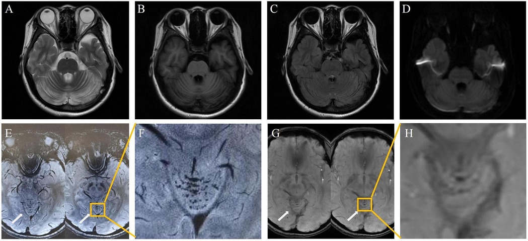 Follow-up MRI showed significant resolution of the cerebellar lesions and multiple punctate microhemorrhages in the cerebellar vermison. Panels A to D show DWI and FLAIR sequences. Panels E and F show 7.0 T MRI SWI squences, and panels G and H show 3.0 T MRI SWI squences.