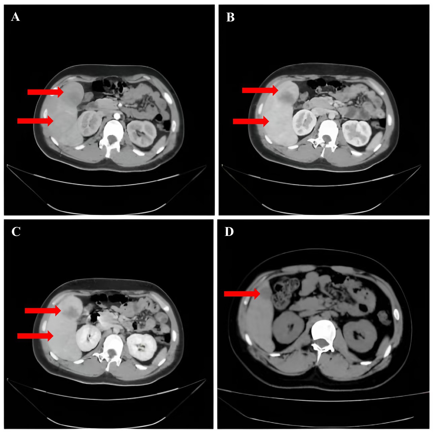 CT scan images of an abdomen divided into four panels labeled A, B, C, and D. Panels A, B, and C show a large mass on the left side of the abdomen, indicated by arrows. Panel D shows a significant reduction in the mass size.