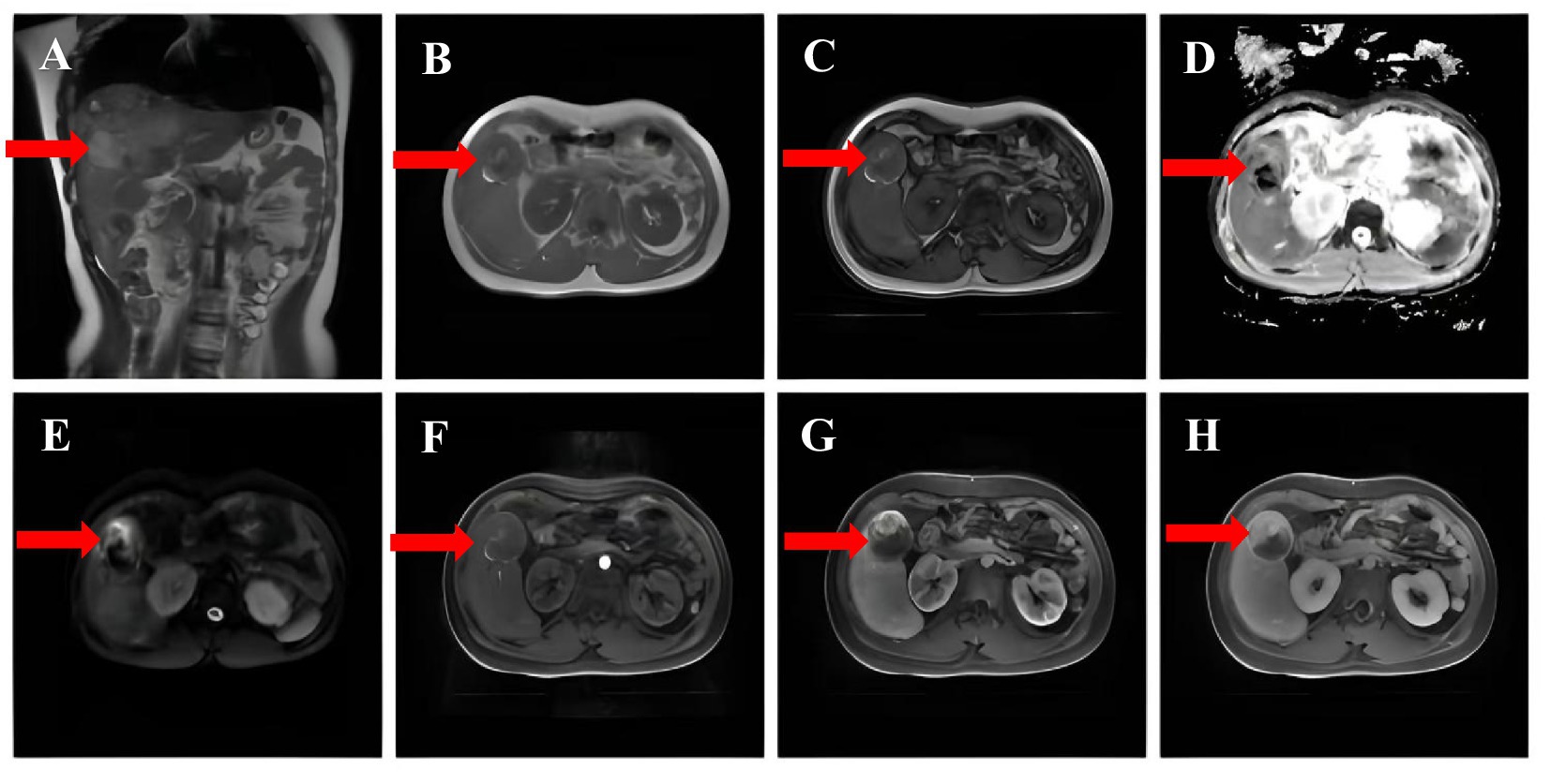 MRI scans labeled A to H show different cross-sections of the abdomen. Each image highlights different areas with red arrows, indicating particular regions of interest. The scans appear to focus on specific details, providing various views for potential analysis.