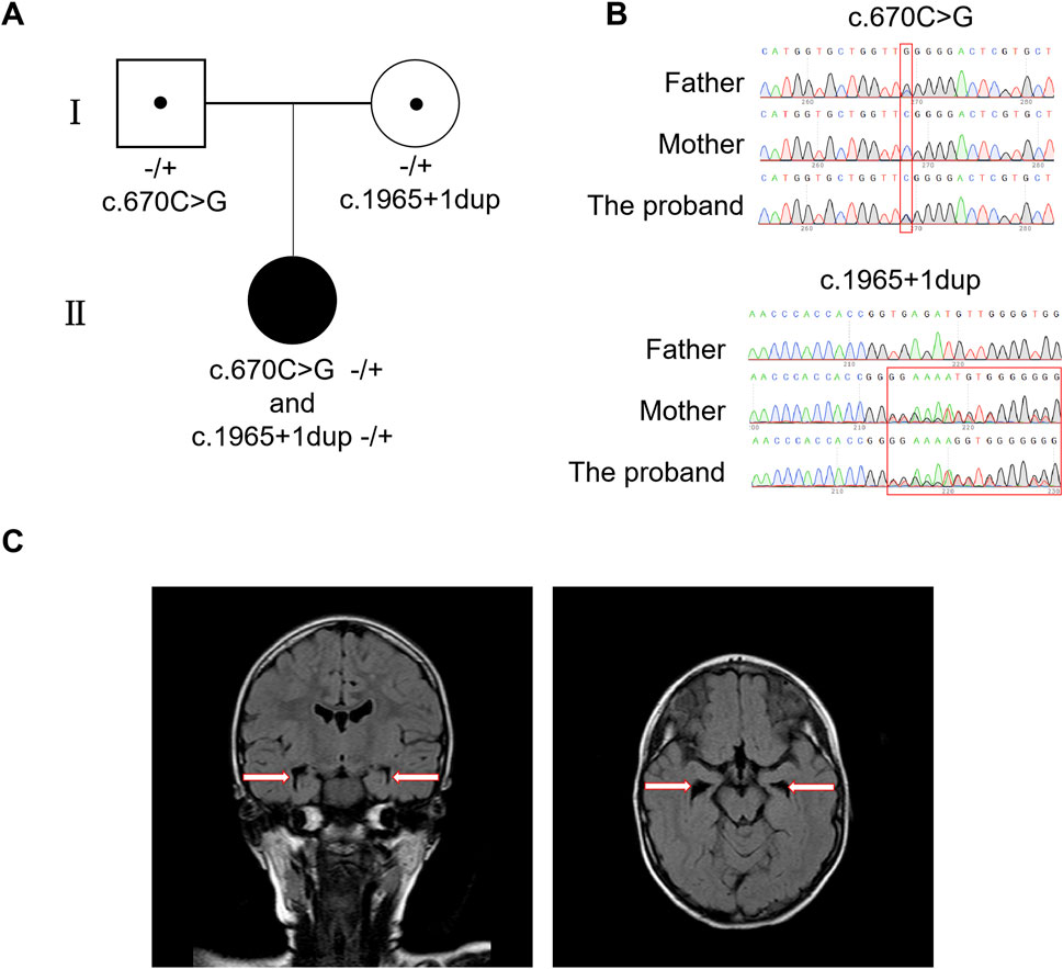 A three-part figure includes:A. A pedigree diagram indicating genetic mutations c.670C>G and c.1965+1dup in a proband and parents.B. DNA sequencing chromatograms showing mutations: c.670C>G in the proband, compared with the father and mother; c.1965+1dup in the proband, compared with both parents.C. Two MRI scans, coronal and axial views, highlighting bilateral brain regions with red arrows.