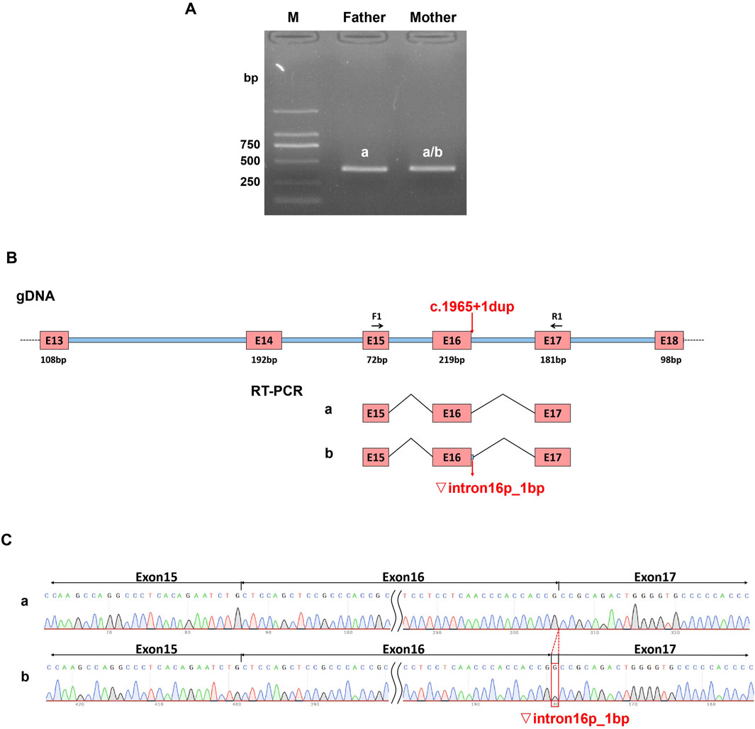 Gel electrophoresis, genetic diagram, and DNA sequencing data related to genetic analysis. Part A shows a gel electrophoresis image with labeled lanes for mother (a/b) and father (a), illustrating the presence of DNA fragments around 500 base pairs. Part B is a schematic representation of genomic DNA highlighting exons, primers, and specific mutations or duplications, denoted by