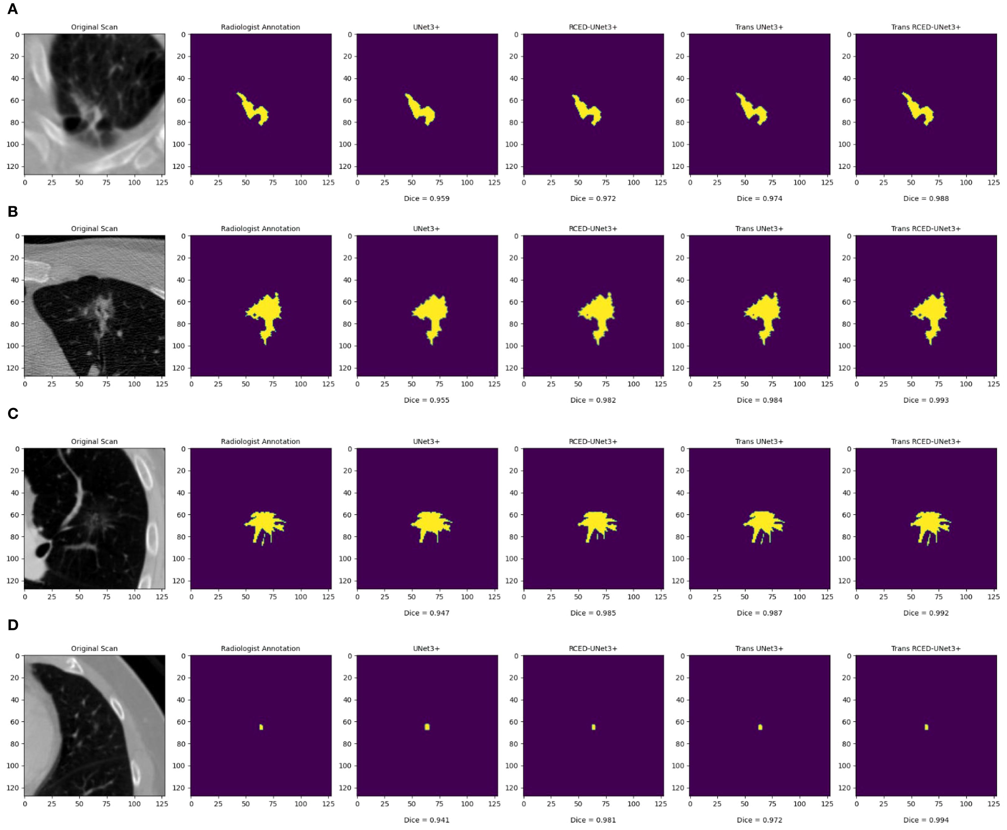 Four panels (A, B, C, D) display CT scan images and segmentation results. Each panel includes an original scan, radiologist annotation, and outputs from different models: UNet3+, PCED-UNet3+, Trans UNet3+, and Trans RCED-UNet3+. Yellow areas indicate segmented regions. Dice scores are provided below each model output, indicating segmentation accuracy.