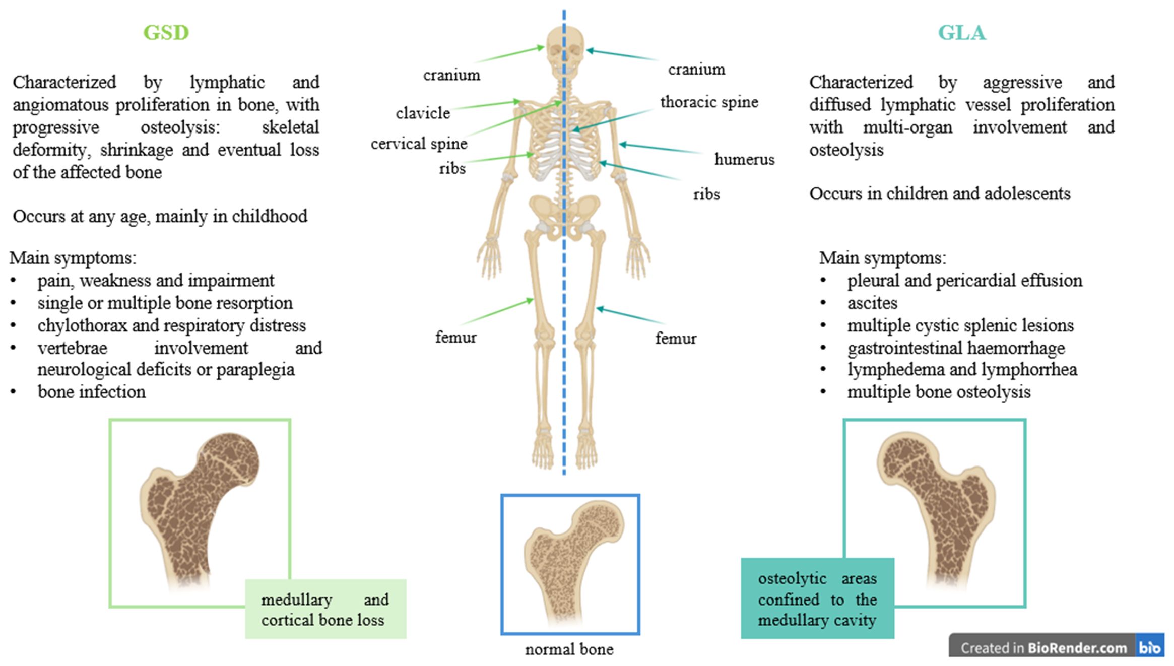 Diagram comparing GSD and GLA. The central skeleton image shows the most affected bones in GSD (left panel) and in GLA (right panel). Left panel describes GSD symptoms, while right panel the GLA ones. Lower pictures illustrate bone differences between diseases compared to healthy bone (middle panel): GSD (left panel) shows medullary and cortical osteolysis, GLA presents medullary osteolysis.