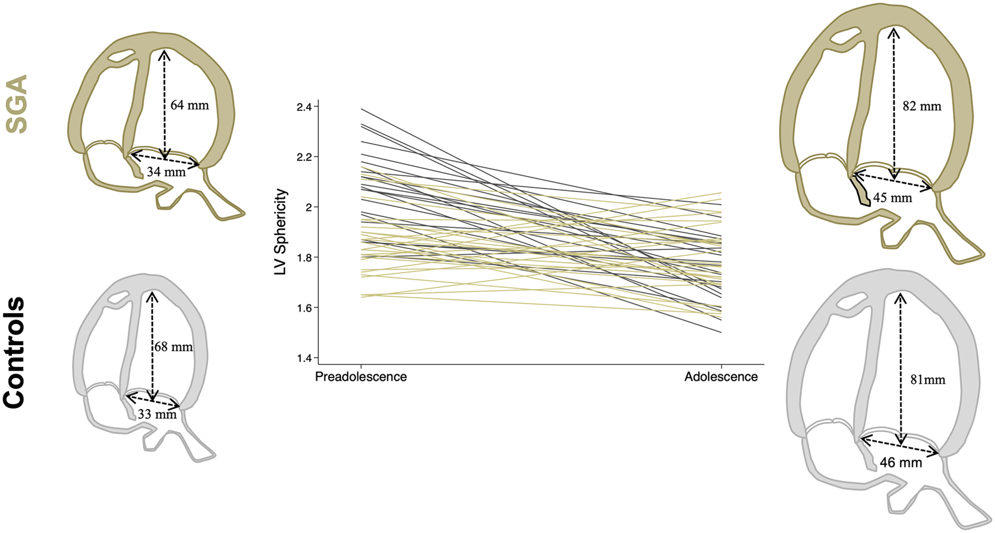 Diagram showing left ventricular (LV) sphericity changes from preadolescence to adolescence in two groups: SGA (small for gestational age) and Controls. It includes anatomical diagrams with measurements. SGA displays 64 mm and 34 mm as well as 82 mm and 45 mm, while Controls show 68 mm and 33 mm, plus 81 mm and 46 mm. A line graph in the center illustrates LV sphericity decreases over time for both groups.