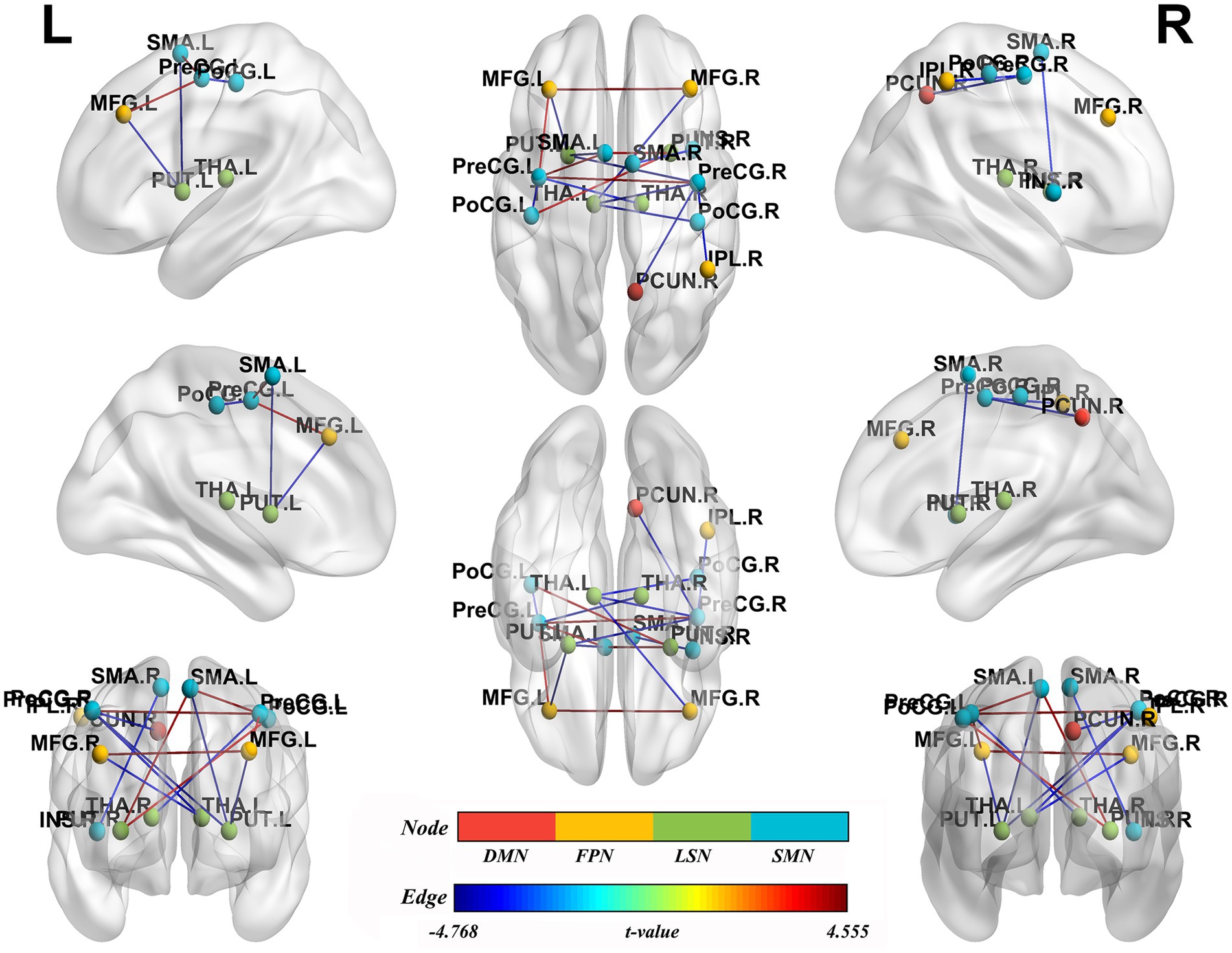 Illustration of brain network connectivity depicted on a three-dimensional brain model, showing nodes and edges labeled with brain regions and color-coded networks. The nodes represent specific brain areas such as SMA, PreCG, PoCG, and MFG on left and right hemispheres. Edges are color-coded from blue to red, indicating t-values. The color legend shows networks: DMN, FPN, LSN, SMN.