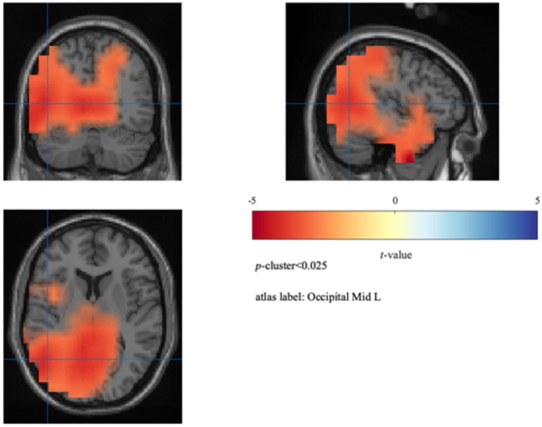 Brain scans with highlighted regions showing significant activation in red. The color bar indicates t-values from negative five in red to positive five in blue. Part of the occipital lobe is labeled
