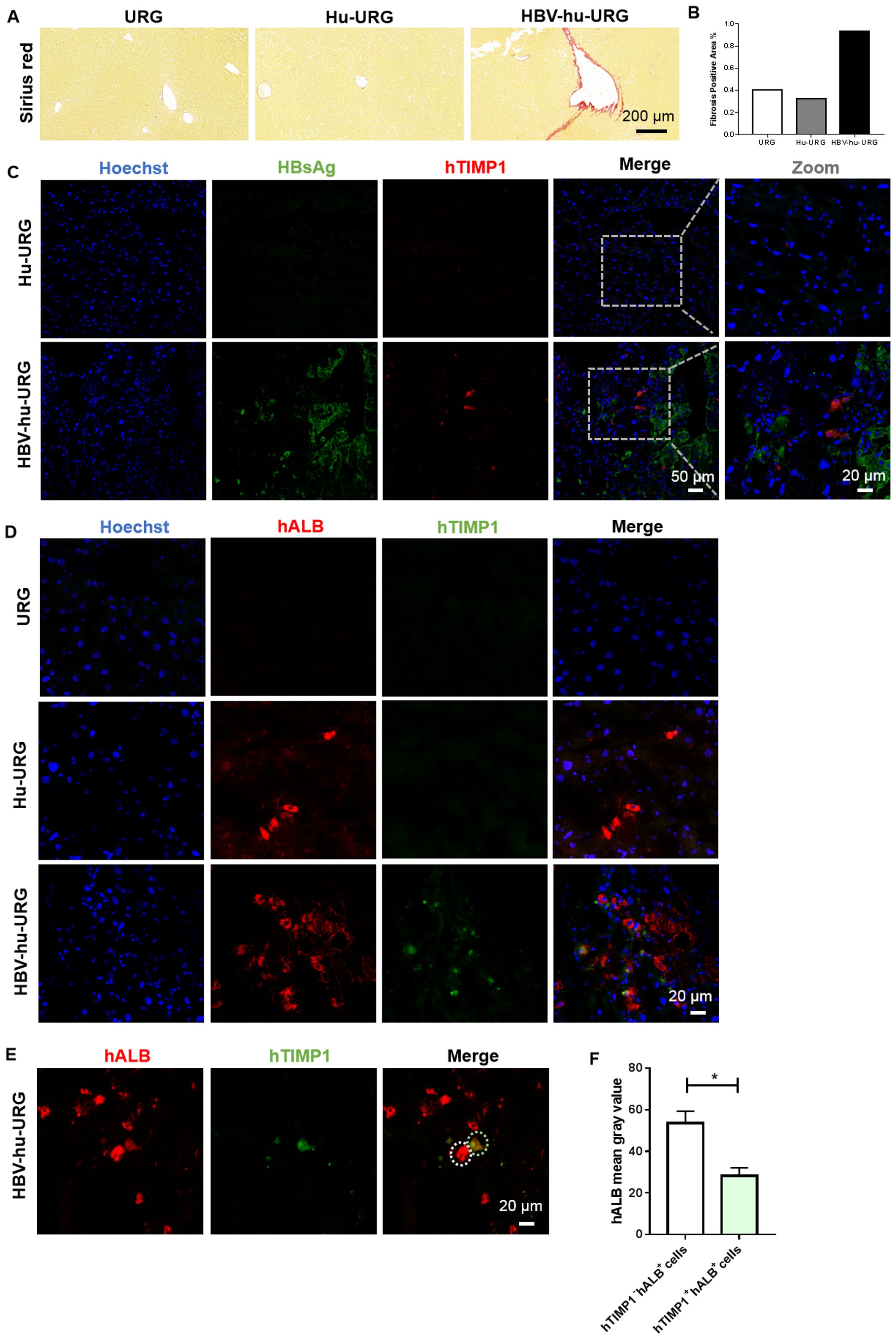 Composite image displaying various panels related to liver fibrosis and protein expression. Panel A shows Sirius red staining for fibrosis in different liver groups (URG, Hu-URG, HBV-hu-URG) with increased staining in HBV-hu-URG. Panel B is a bar graph showing fibrotic area quantification, highest in HBV-hu-URG. Panels C and D show fluorescence microscopy images with blue (Hoechst), green (HBsAg/hTIMP1), and red (hTIMP1/hALB) staining, demonstrating protein expression differences. Panel E focuses on hALB and hTIMP1 colocalization. Panel F is a bar chart illustrating hALB expression levels, showing significant differences.