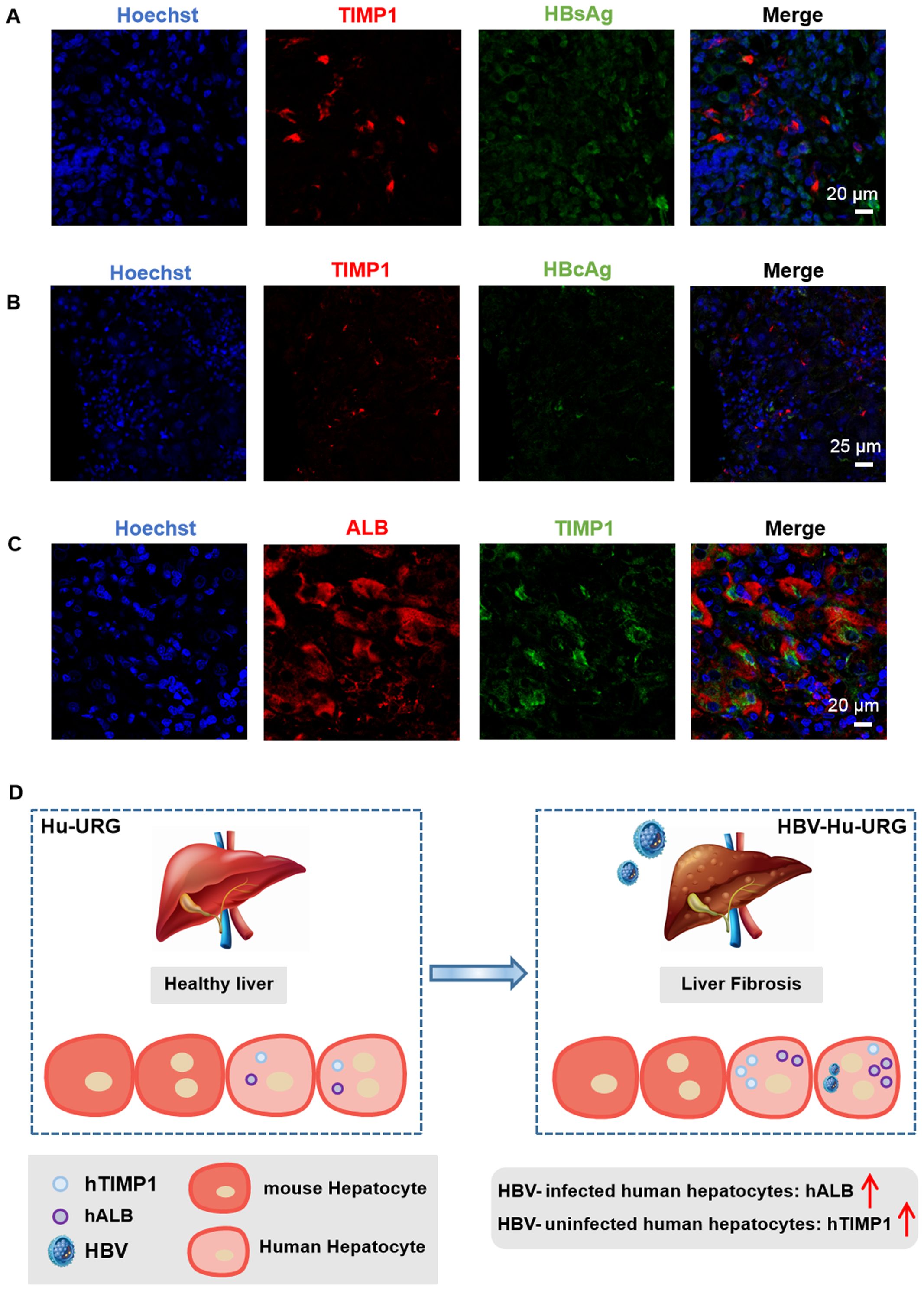 Panel A shows immunofluorescence images with Hoechst, TIMP1, HBsAg, and a merged view, indicating cell marker expression and their overlap at 20 micrometers. Panel B includes similar markers but with HBcAg, shown at 25 micrometers. Panel C displays images of Hoechst, ALB, TIMP1, and a merged view, indicating protein expression overlap at 20 micrometers. Panel D is a diagram comparing a healthy liver (Hu-URG) to a liver with fibrosis (HBV-Hu-URG), showing hTIMP1, hALB, and HBV in mouse and human hepatocytes, illustrating changes from infection.