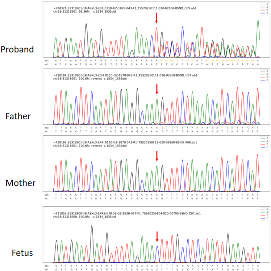 DNA sequencing chromatograms for four individuals: Proband, Father, Mother, and Fetus. Each chromatogram shows peaks representing nucleotide sequences with arrows indicating specific points of interest. The sequences indicate a deletion mutation c.1534_1535del.