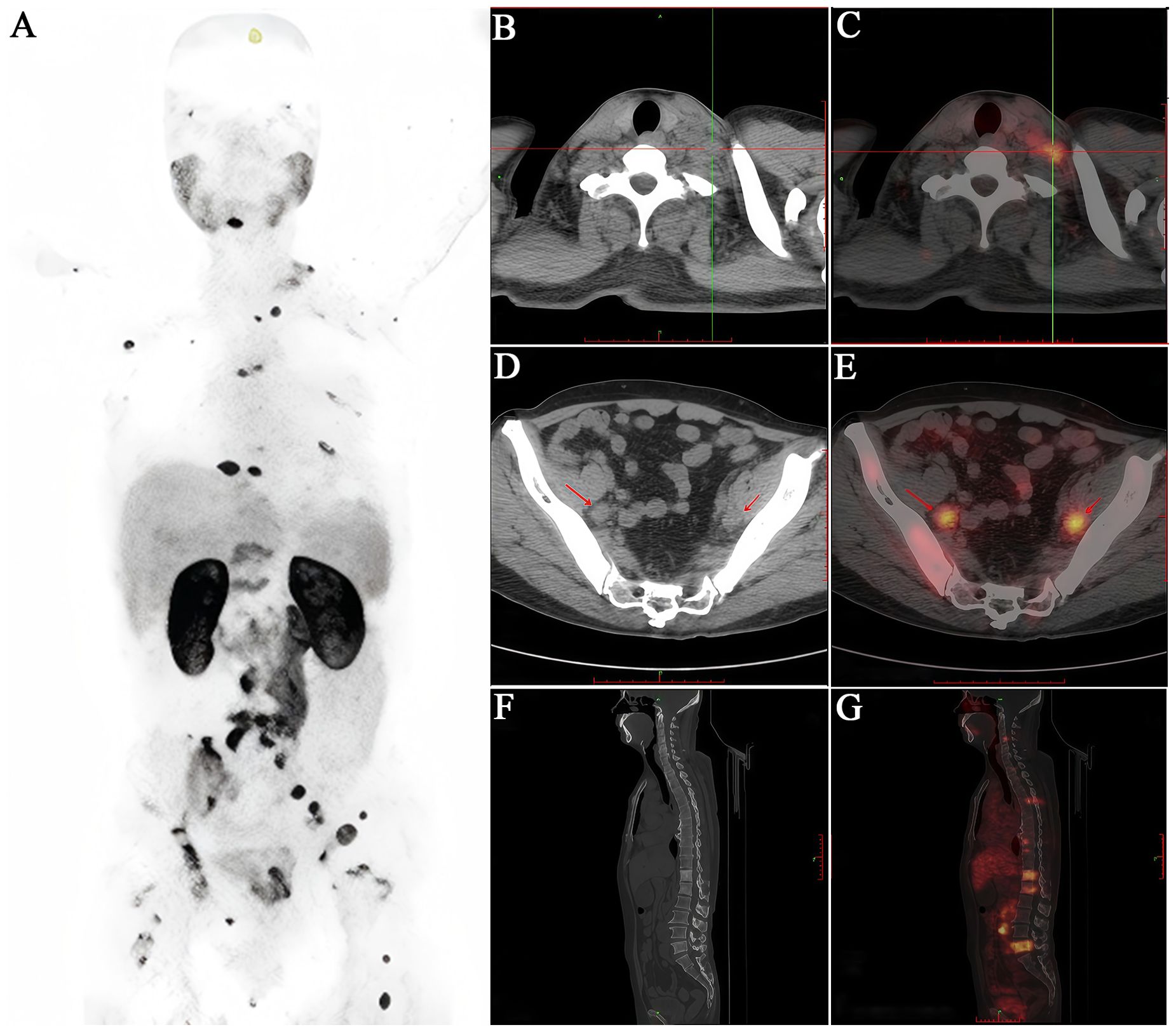 Composite medical images showing scans of a human body. Image A: A full-body PET scan displaying areas of differing intensities. Images B and C: Axial CT and PET scans of the upper torso. Images D and E: Axial CT and PET scans of the pelvic area with highlighted regions. Images F and G: Sagittal CT and PET scans of the torso highlighting specific areas.