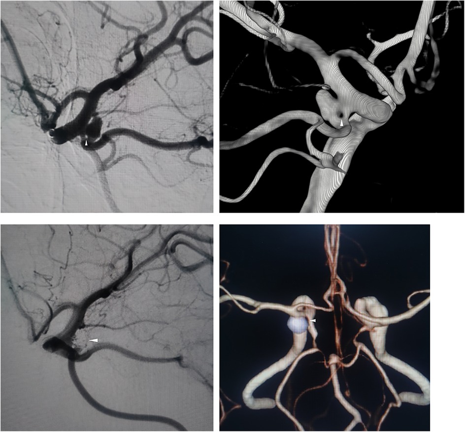 Four medical images showing cerebral artery views. The top left and bottom left images are grayscale angiograms depicting detailed branching of blood vessels. The top right and bottom right images are 3D reconstructions showing the intricate vascular structure with clear representation of vessel pathways, possibly highlighting aneurysms or irregularities. The images collectively emphasize the complex network of cerebral arteries.