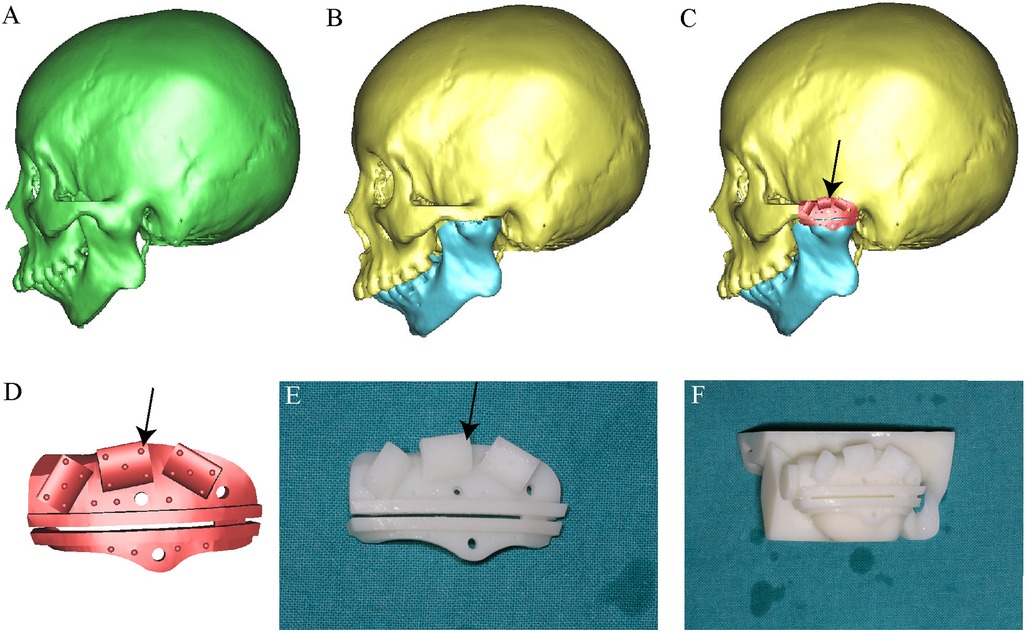 Illustration showing six panels of skull and prosthetic models. Panels A to C display side views of a skull with varying colors. A is green, B is yellow with a blue section at the jaw, and C adds a red highlighted area marked by an arrow. Panel D is a detailed red prosthetic model, with an arrow indicating a specific section. Panels E and F show white physical prototypes of the prosthetic on a blue surface, with E containing an arrow pointing to a segment.