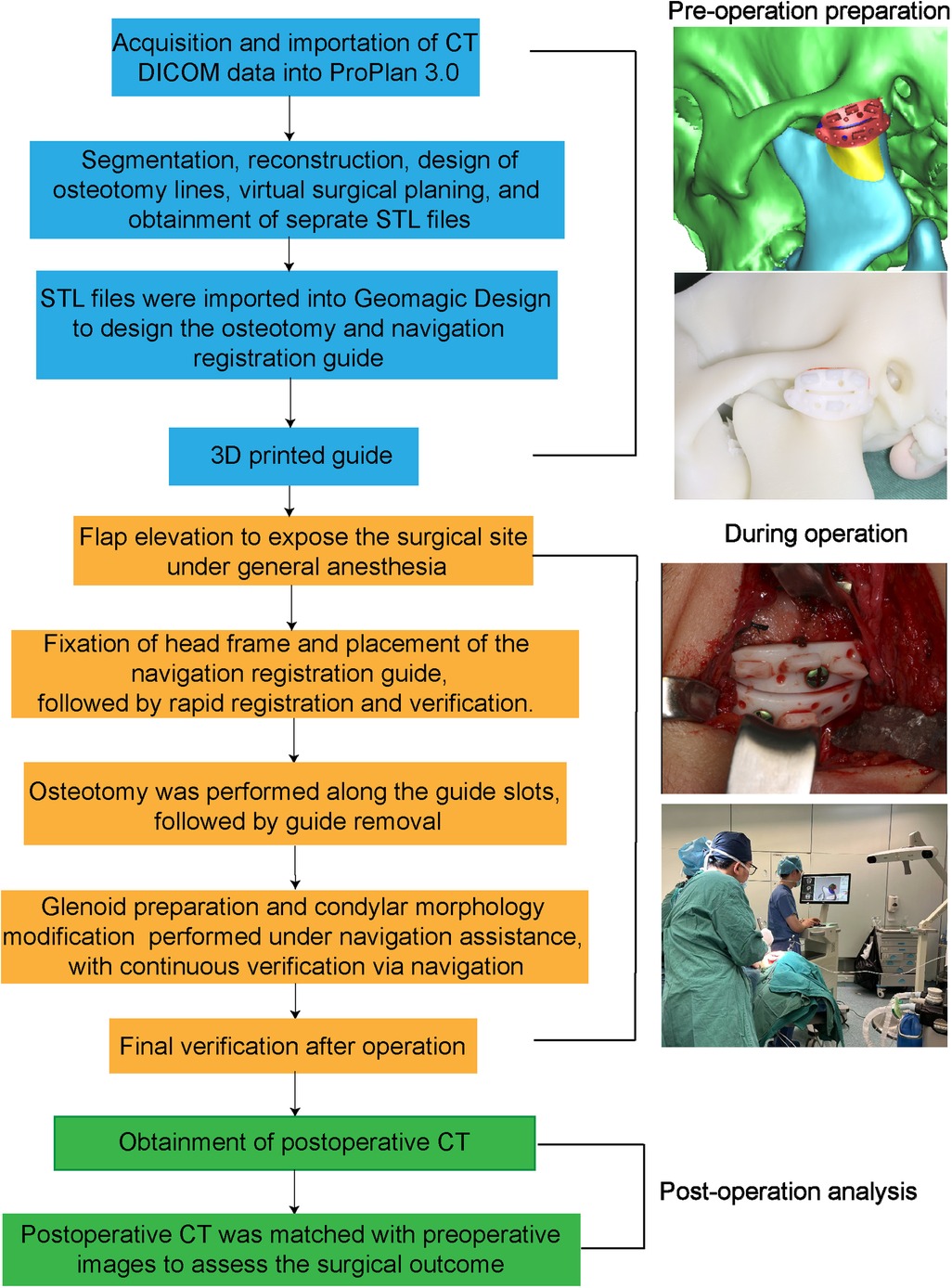 Flowchart detailing the surgical process of using a 3D printed guide for osteotomy, including pre-operation preparation, surgery, and post-operation analysis. Steps include CT data acquisition, guide design, surgery under general anesthesia, osteotomy, verification, and CT assessment. Images show 3D modeling, surgical site with guide in place, and surgeons operating, corresponding to different phases of the procedure.