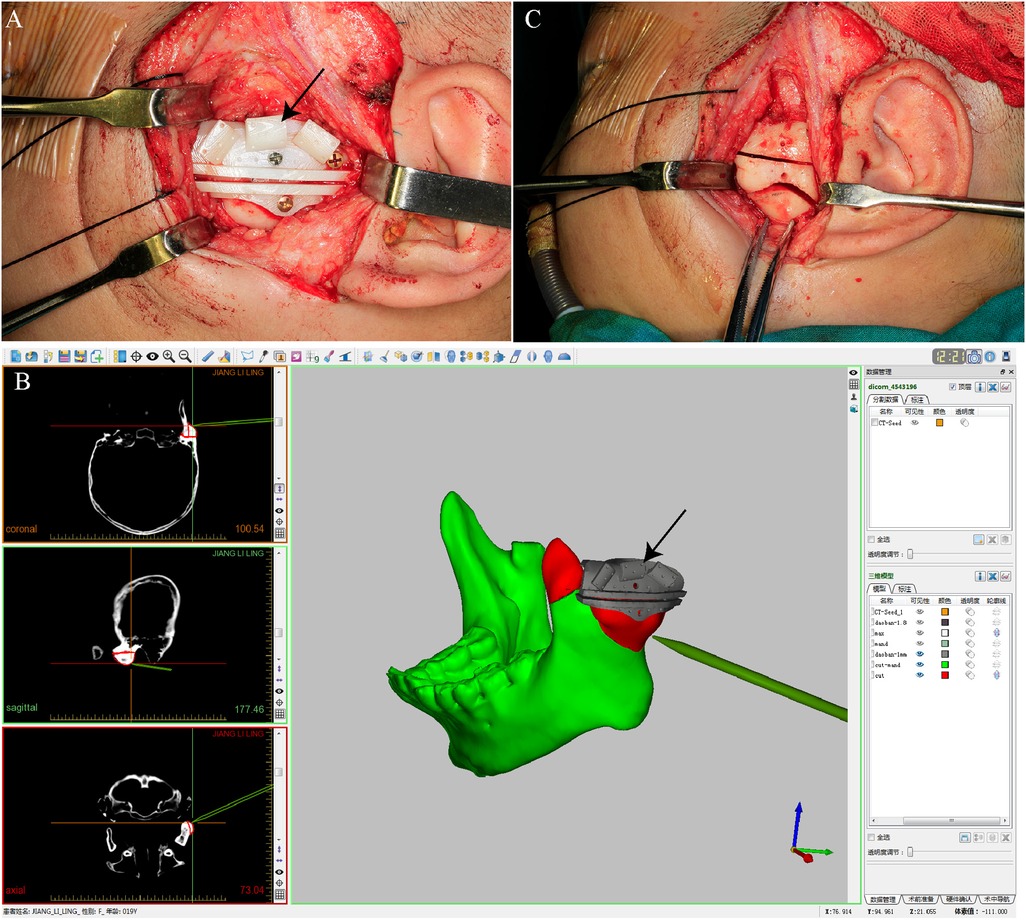 Image composed of three panels. Panel A shows an open surgical site near the ear with a white implant secured by screws. Panel B is a computer screen displaying CT scans in coronal, sagittal, and axial views, alongside a 3D model of a skull showing the implant's position. Panel C depicts a different angle of the surgical site, with the implant visible inside. Surgical tools are present in panels A and C.