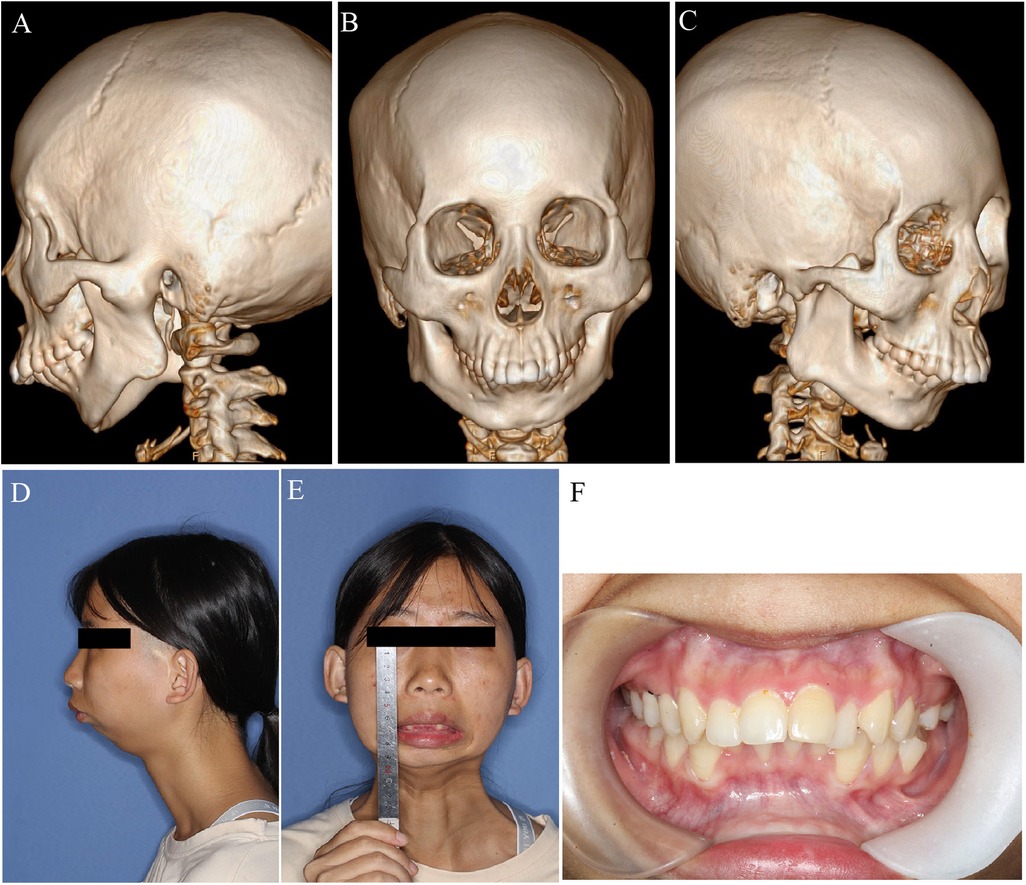 Multiple panels show cranial and facial features. A-C: 3D skull scans from different angles. D-E: Profile and frontal photos of a person with features obscured. F: Close-up of dental alignment with gums and teeth visible.